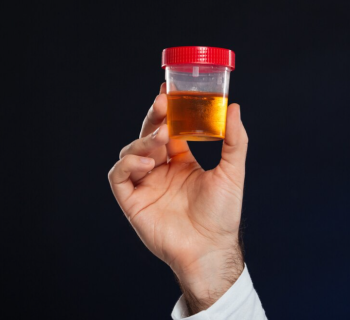 O que a cor da urina diz sobre a sua saúde e quando buscar exames médicos